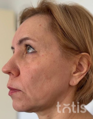 Rezultaty Zestaw TESSLIFT SOFT V-DERM (10 nici) + Bandaż + kaniula SoftFil 18G 70mm + igła 18G  фото до #1
