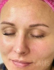 Результати 02 Me Line Caucasian Skin Day  фото после #2
