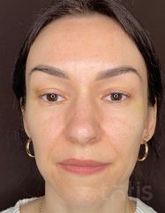 Результати Facetem S 1.5ml *1 шт. + конектор  фото до #1