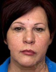 Результати Facetem S 1.5ml *1 шт. + конектор  фото после #2