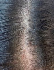 Результати Plinest Hair  фото после #2