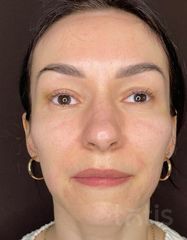 Результати Facetem S 1.5ml *1 шт. + конектор  фото после #2