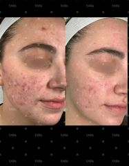 Результаты Rosacea Relief NEW  фото после #2