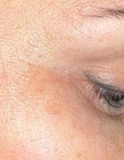 Результати Plinest Eye  фото после #2
