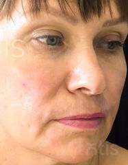 Результати Facetem S 1.5ml *1 шт. + конектор  фото после #2