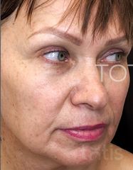 Výsledky Facetem S 0.8mlx2  фото до #1