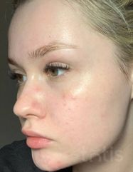 Результати Cleansing Gel  фото после #2