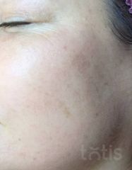 Результати 01 Me Line Caucasian Skin  фото после #2