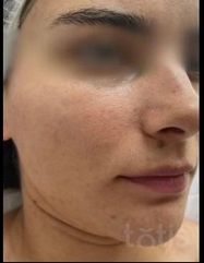 Результати Hydro-Marin® Cream Light  фото до #1