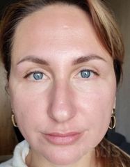 Результати Professional Peptide Perfection Exfoliator  фото после #2