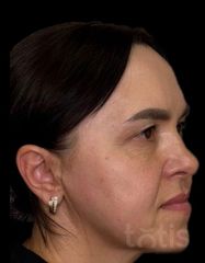 Rezultate Facetem S 0.8ml * 1 seringă  фото после #2
