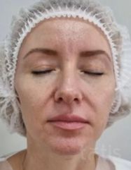 Результати Facetem S 1,5 ml  фото до #1