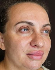 Результати Facetem S 1.5ml *1 шт. + конектор  фото после #2