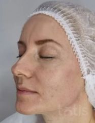 Rezultate Facetem S 0.8ml * 1 seringă  фото после #2