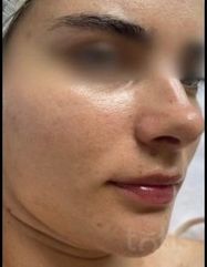 Výsledky Hydro-Marin® Serum  фото после #2
