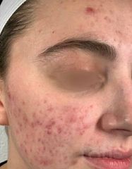 Результаты Foaming Cleanser with Amino Acids  фото до #1