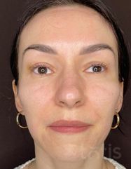 Результати Facetem S 1.5ml *1 шт. + конектор  фото после #2