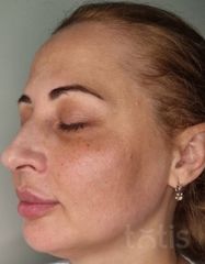 Результати Facetem S 1,5 ml  фото после #2