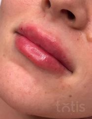 Результати Saypha Filler Lidocaine NEW  фото до #1