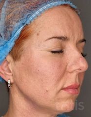 Результати Facetem S 1,5 ml  фото после #2