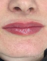 Результати Saypha Filler Lidocaine NEW  фото после #2