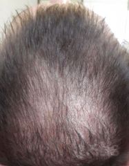 Результати XTRA HAIR RESTORER LOTION  фото до #1