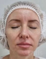 Rezultate Facetem S 0.8ml * 1 seringă  фото до #1