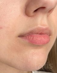 Результати Saypha Filler Lidocaine NEW  фото до #1