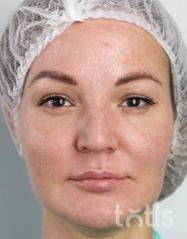 Rezultaty Zestaw TESSLIFT SOFT V-DERM (10 nici) + Bandaż + kaniula SoftFil 18G 70mm + igła 18G  фото после #2