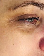 Результаты ULTIMATE EYE CORRECTOR  фото до #1