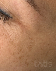Результати Whitening De Pigmentor Serum  фото до #1