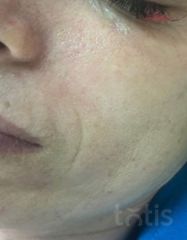 Результати Professional Tightening Protein Booster  фото после #2