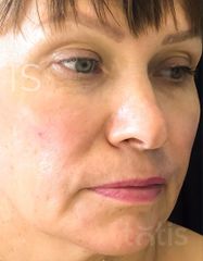 Rezultate Facetem S 0.8ml * 1 seringă  фото после #2