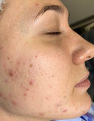 Rezultate SKIN RECOVERY  фото до #1