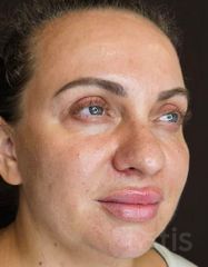 Результати 02 Me Line Caucasian Skin Day  фото после #2