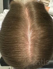 Результати Plinest Hair  фото до #1