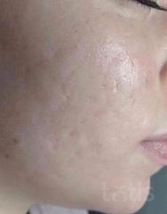 Rezultate SKIN RECOVERY  фото после #2