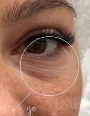 Результати Plinest Eye  фото до #1