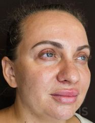 Výsledky Facetem S 0.8mlx2  фото после #2