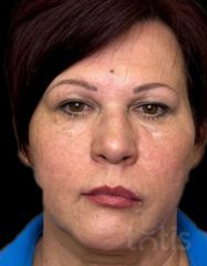 Результати Facetem S 1,5 ml  фото после #2