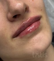 Результаты Saypha Filler Lidocaine NEW  фото после #2
