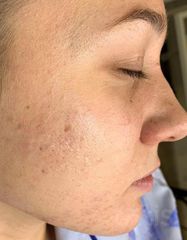 Rezultate SKIN RECOVERY  фото после #2