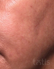 Результати 01 Me Line Caucasian Skin  фото после #2
