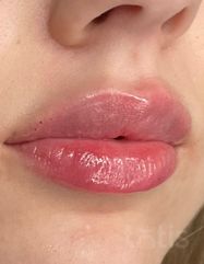 Результати Saypha Filler Lidocaine NEW  фото после #2
