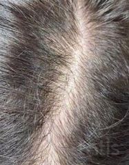 Результати Plinest Hair  фото до #1