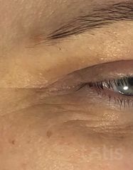 Результаты ULTIMATE EYE CORRECTOR  фото до #1