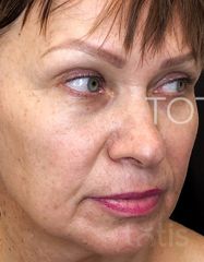 Результати Facetem S 1.5ml *1 шт. + конектор  фото до #1