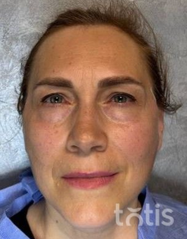 Rezultaty Zestaw TESSLIFT SOFT V-DERM (10 nici) + Bandaż + kaniula SoftFil 18G 70mm + igła 18G  фото после #2
