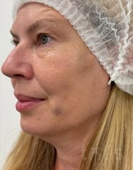 Результати Набір TESSLIFT SOFT V-DERM (10 ниток) + Бандаж + канюля SoftFil 18G 70mm + 18G*40mm голка  фото после #2