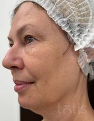 Результаты Набор TESSLIFT SOFT V-DERM (10 нитей) + Бандаж + канюля SoftFil 18G 90mm + 18G*40mm игла  фото до #1